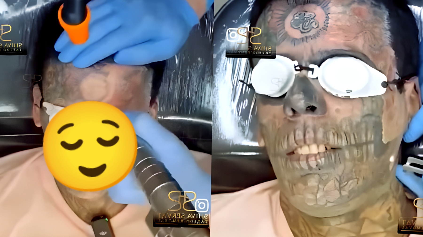L'ex uomo più tatuato del Brasile rivela un metodo di rimozione dei tatuaggi incredibilmente efficace